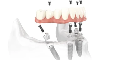 all on 4 - Zenith dental cabinet