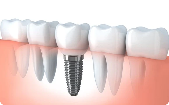 Pose implant unitaire au cabinet dentaire Zenith à Boissy-l’Aillerie à proximité de Cergy-Pontoise et de Paris