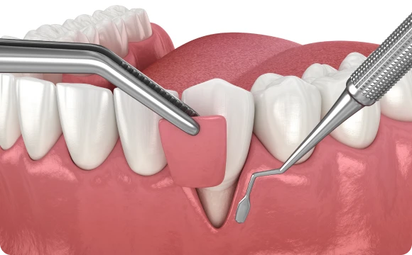 Greffe de gencive, greffe gingivale à Zenith Dental cabinet à Boissy-l’Aillerie à proximité de Cergy-Pontoise et de Paris